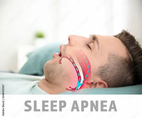 Understanding Obstructive Sleep Apnea (OSA)